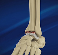 Foot and Ankle Osteoarthritis